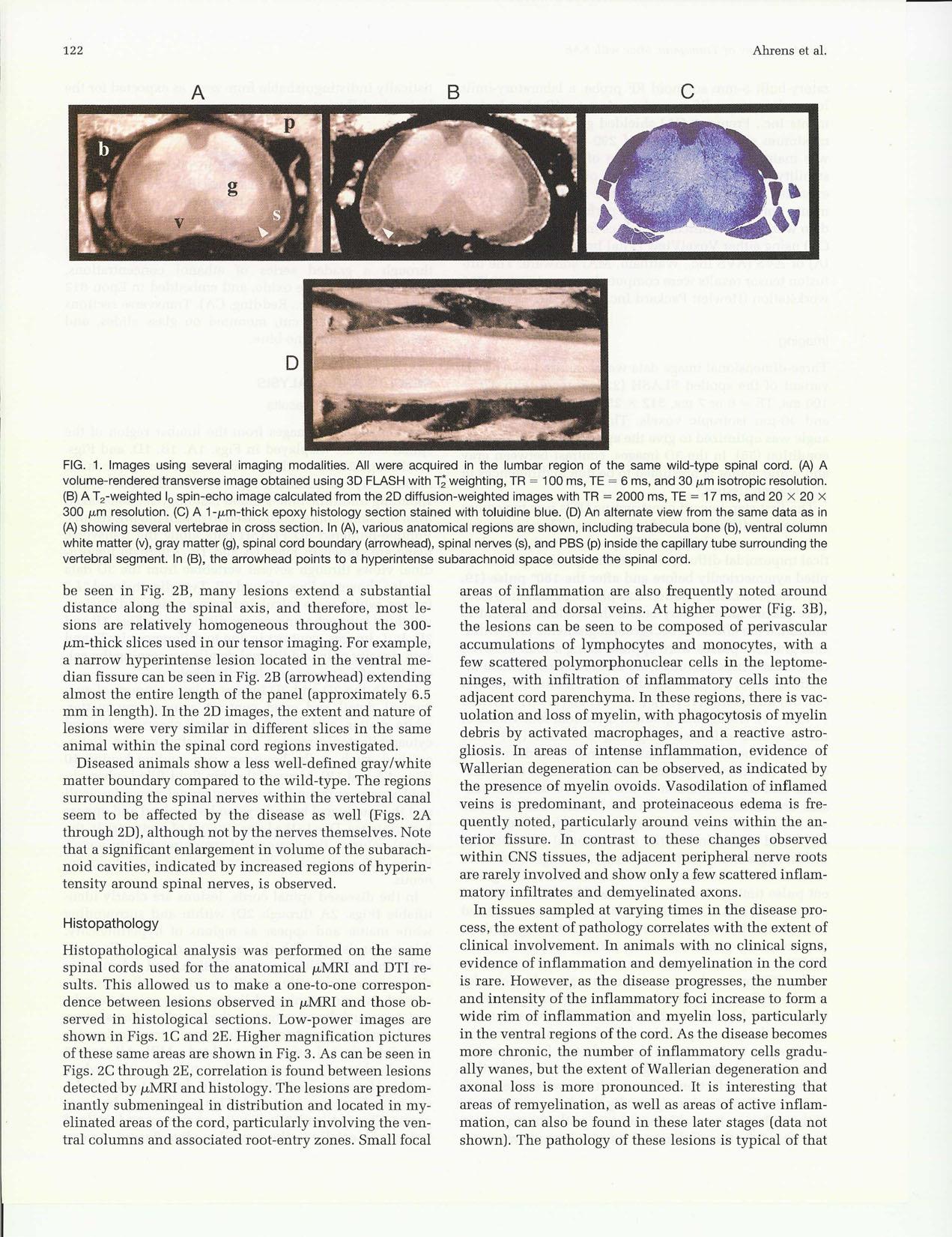 {MR} Microscopy of Transgenic Mice that Spontaneously Aquire Experimental Allergic Encephalomyelitis