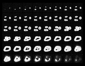 Geometric Model Extraction from Magnetic Resonance Volume Data