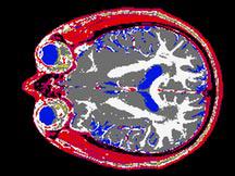 Geometric Model Extraction from Magnetic Resonance Volume Data