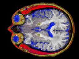 Continuous {B}ayesian Tissue Classification for Visualization Techniques