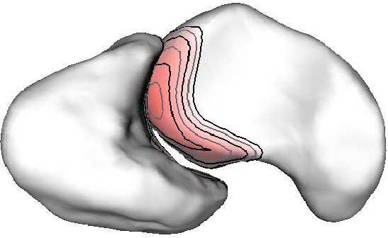 JointViewer an interactive system for exploring orthopedic data