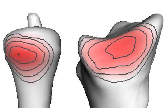 JointViewer an interactive system for exploring orthopedic data