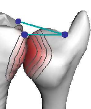 JointViewer an interactive system for exploring orthopedic data