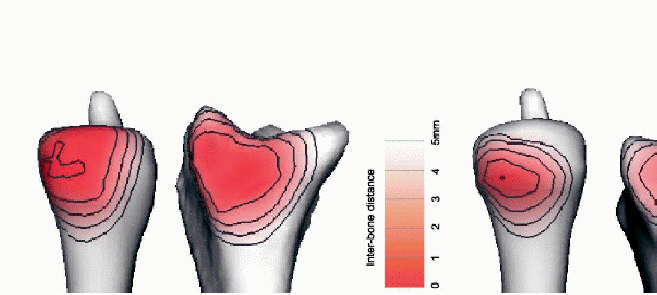 JointViewer an interactive system for exploring orthopedic data