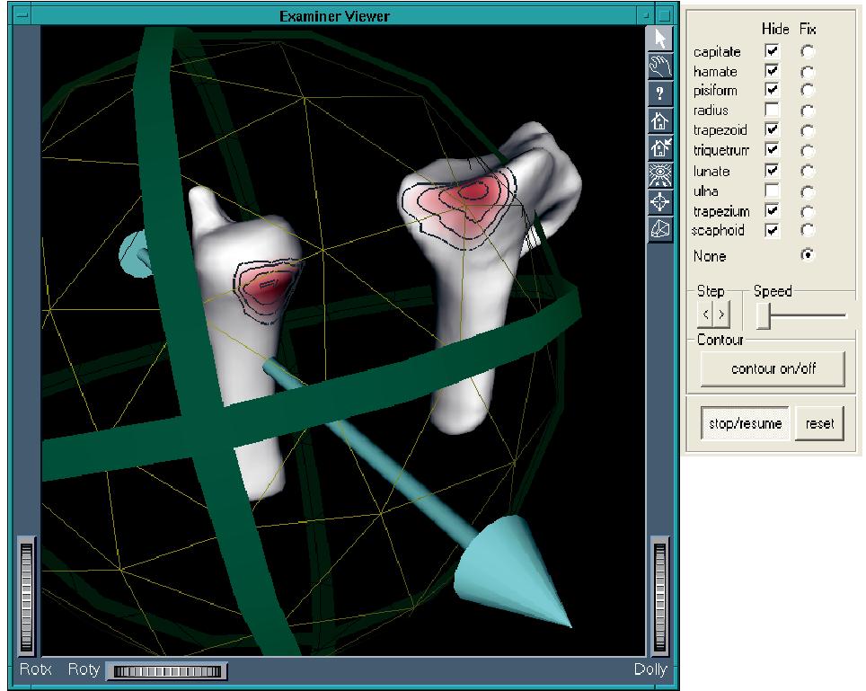 JointViewer an interactive system for exploring orthopedic data