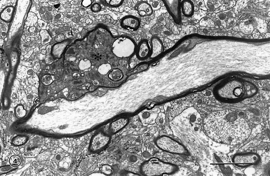 The effects of normal aging on myelin and nerve fibers: A review