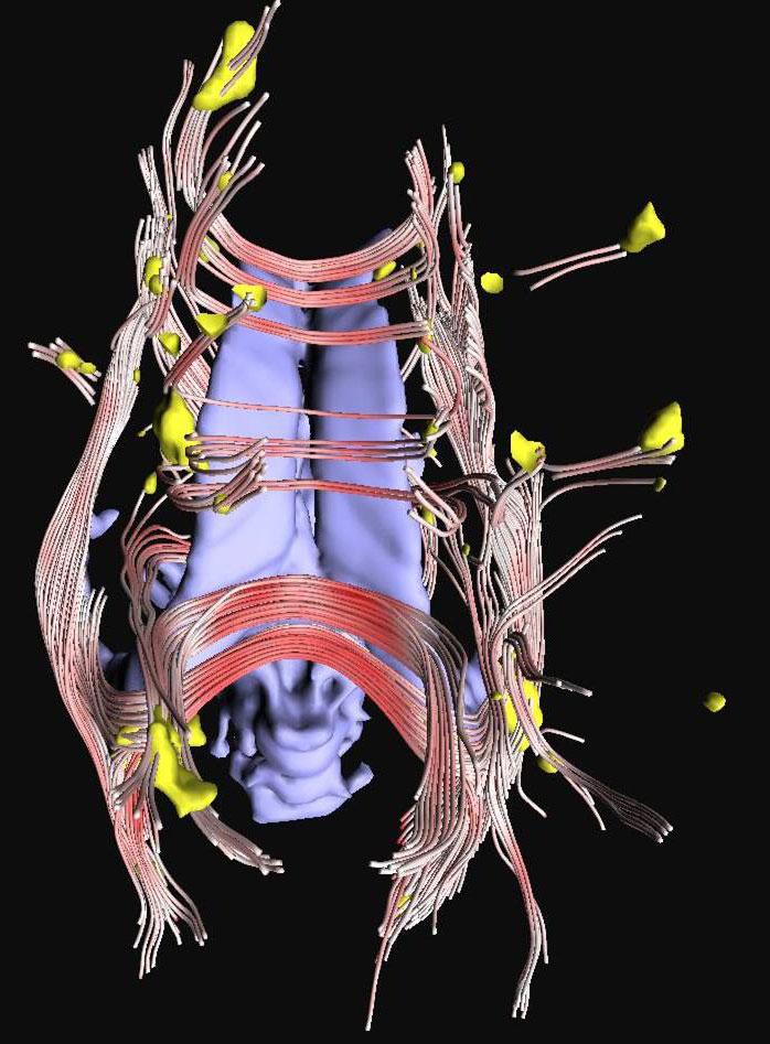 Strategy for Detecting Neuronal Fibers at Risk for Neurodegeneration In Earliest {MS} by Streamtube Tractography at {3T}