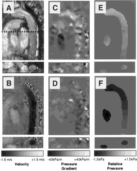 Three-dimensional Time-resolved ({4D}) Relative Pressure Mapping using Magnetic Resonance Imaging