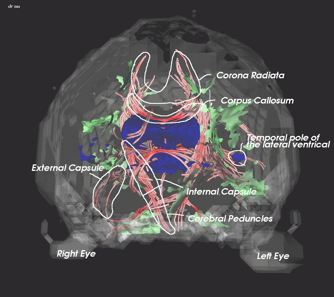 Streamtubes and Streamsurfaces for Visualizing Diffusion Tensor {MRI} Volume Images