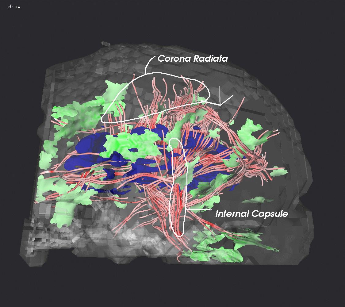 Streamtubes and Streamsurfaces for Visualizing Diffusion Tensor {MRI} Volume Images