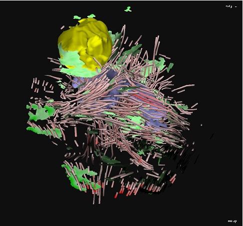 Application of {DTI} Visualization and Analysis on a Data Set from a Brain Tumor Patient