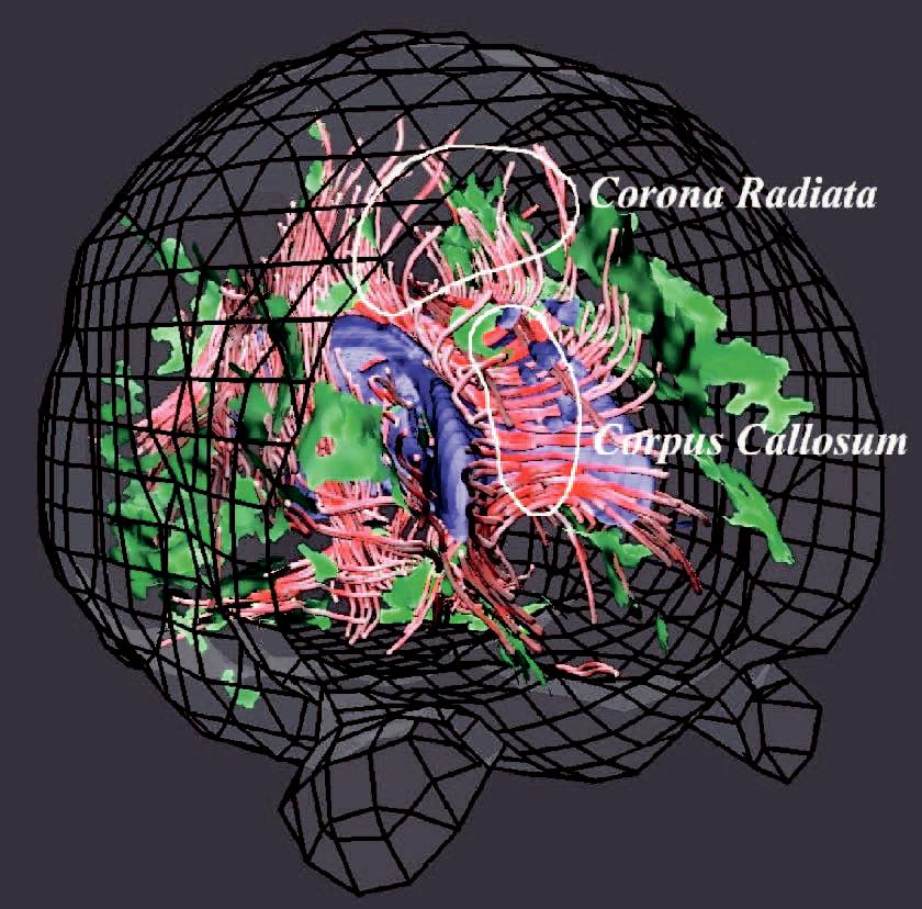 Visualizing Diffusion Tensor {MR} Images Using Streamtubes and Streamsurfaces