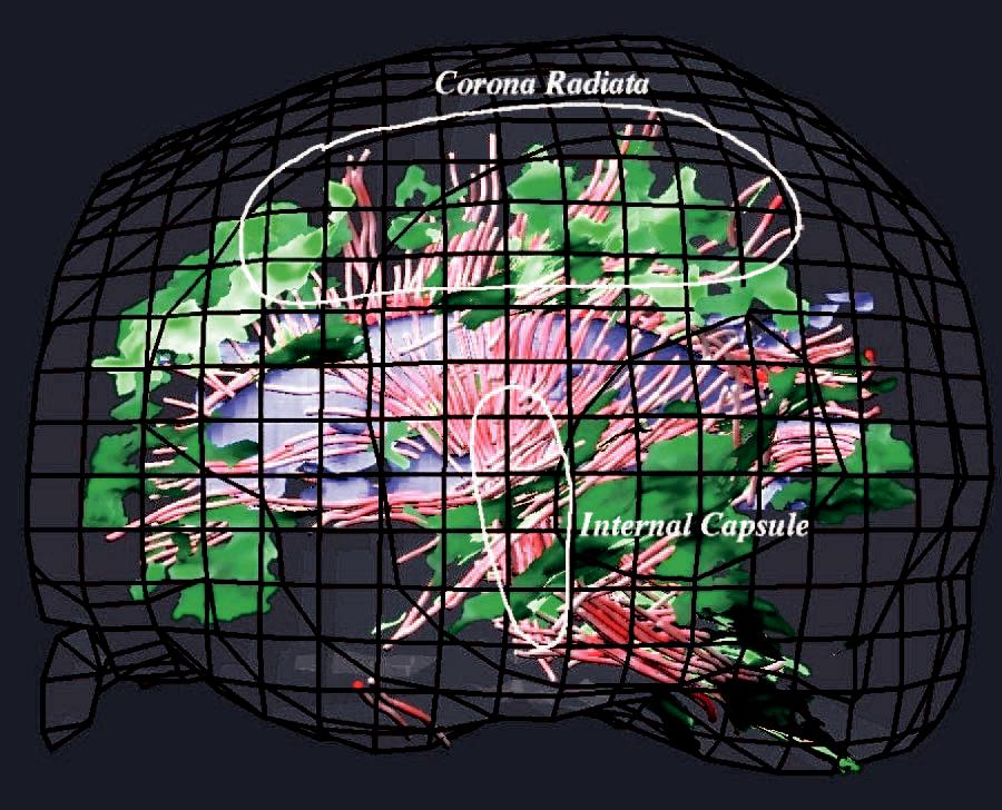 Visualizing Diffusion Tensor {MR} Images Using Streamtubes and Streamsurfaces