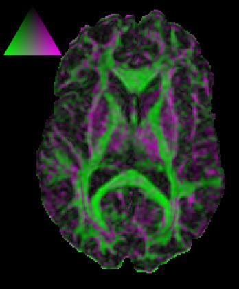 Diffusion Tensor {MRI} Visualization