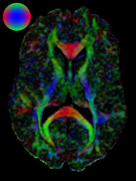 Diffusion Tensor {MRI} Visualization