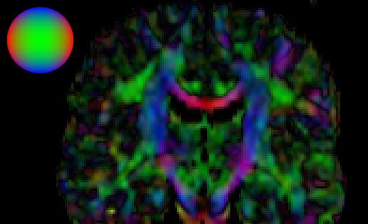 Diffusion Tensor {MRI} Visualization