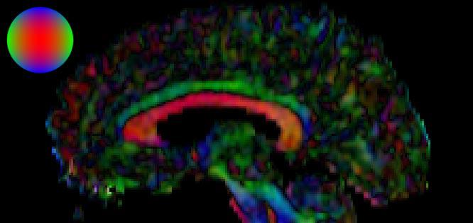 Diffusion Tensor {MRI} Visualization