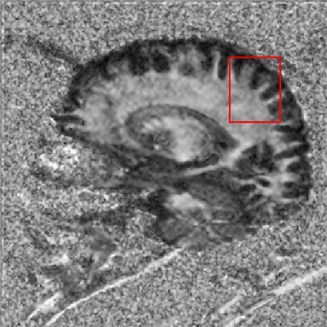A Model for some Subcortical {DTI} Planar and Linear Anisotropy