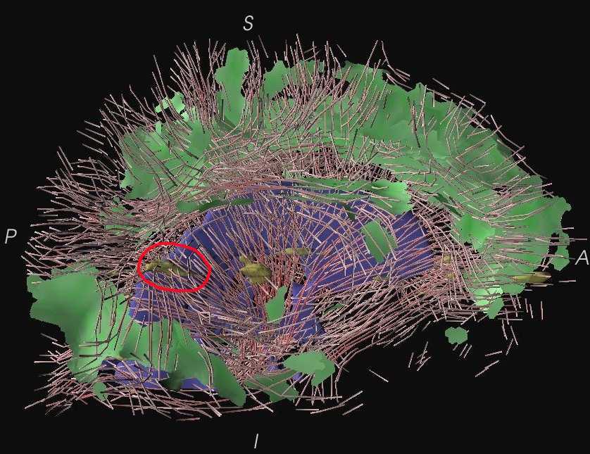Visualization of the Interaction of Multiple Sclerosis lesions with adjacent white matter fibers using Streamtubes and Streamsurfaces
