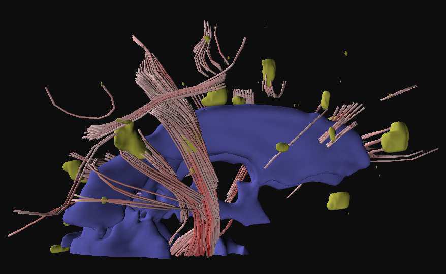 Visualization of the Interaction of Multiple Sclerosis lesions with adjacent white matter fibers using Streamtubes and Streamsurfaces