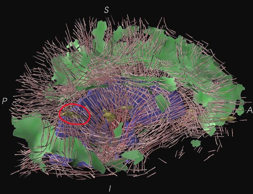 Visualization of the Interaction of Multiple Sclerosis lesions with adjacent white matter fibers using Streamtubes and Streamsurfaces