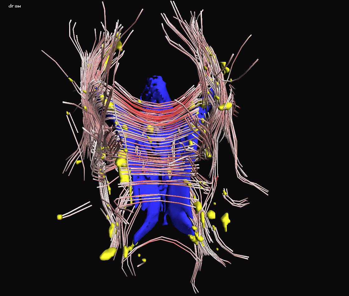Visualization of the Interaction of Multiple Sclerosis lesions with adjacent white matter fibers using Streamtubes and Streamsurfaces