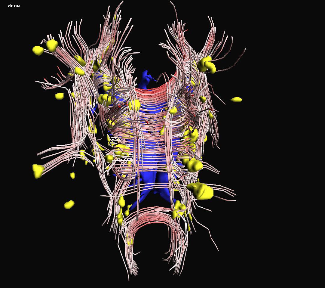 Visualization of the Interaction of Multiple Sclerosis lesions with adjacent white matter fibers using Streamtubes and Streamsurfaces